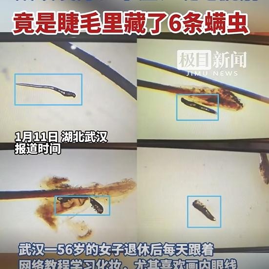 56歲女士眼睫毛內發現6條蠕形蟎。（新浪微博）