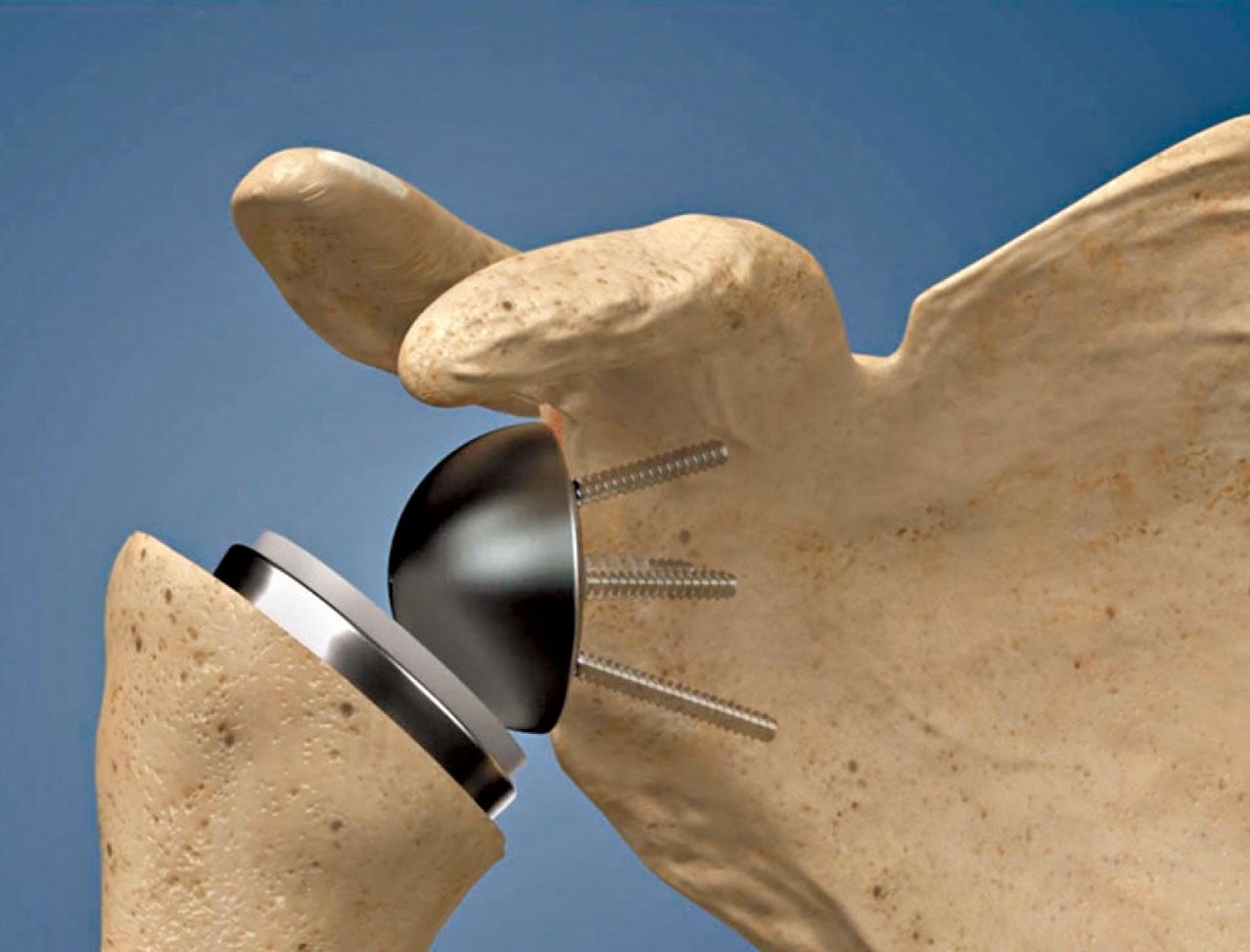 反置式人工肩關節置換術