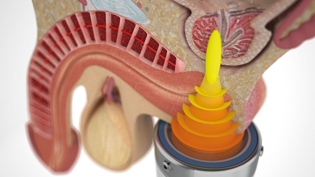 震波治療慢性前列腺炎的程序