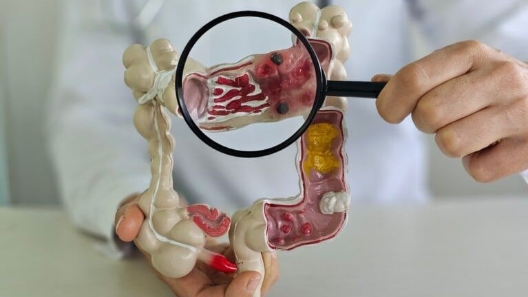 醫學新發現 免疫細胞有兩面 或造就大腸癌新治療