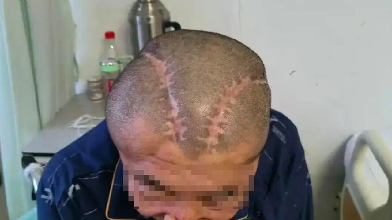 醫療失誤｜右腦出血開錯左腦內蒙男癱瘓　家屬向醫院索償300萬被拒