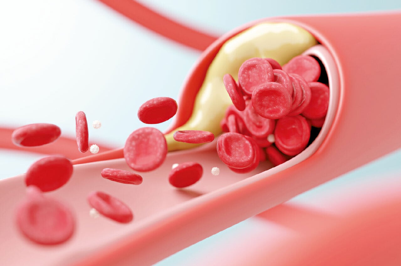 糖尿病人 精準評估+藥物保護 防心臟病發