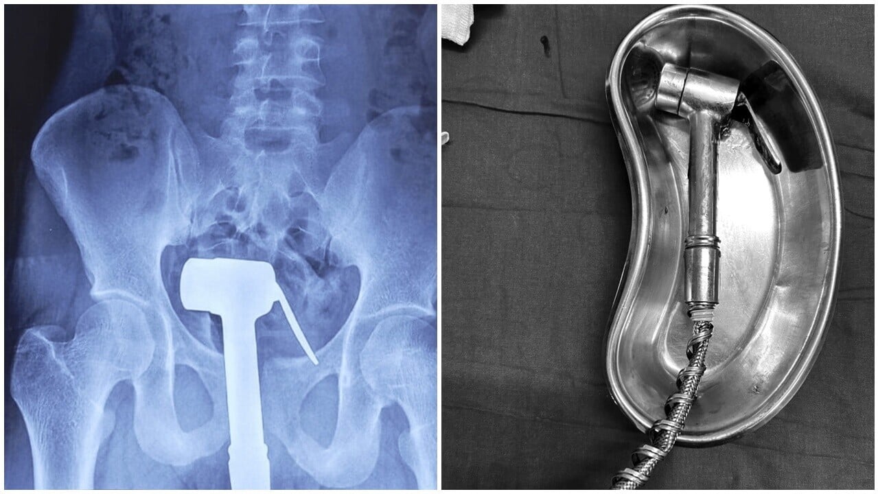 23歲男淋浴器卡菊，狼狽夾住水管求醫。(Cureus Journal of Medical Science)