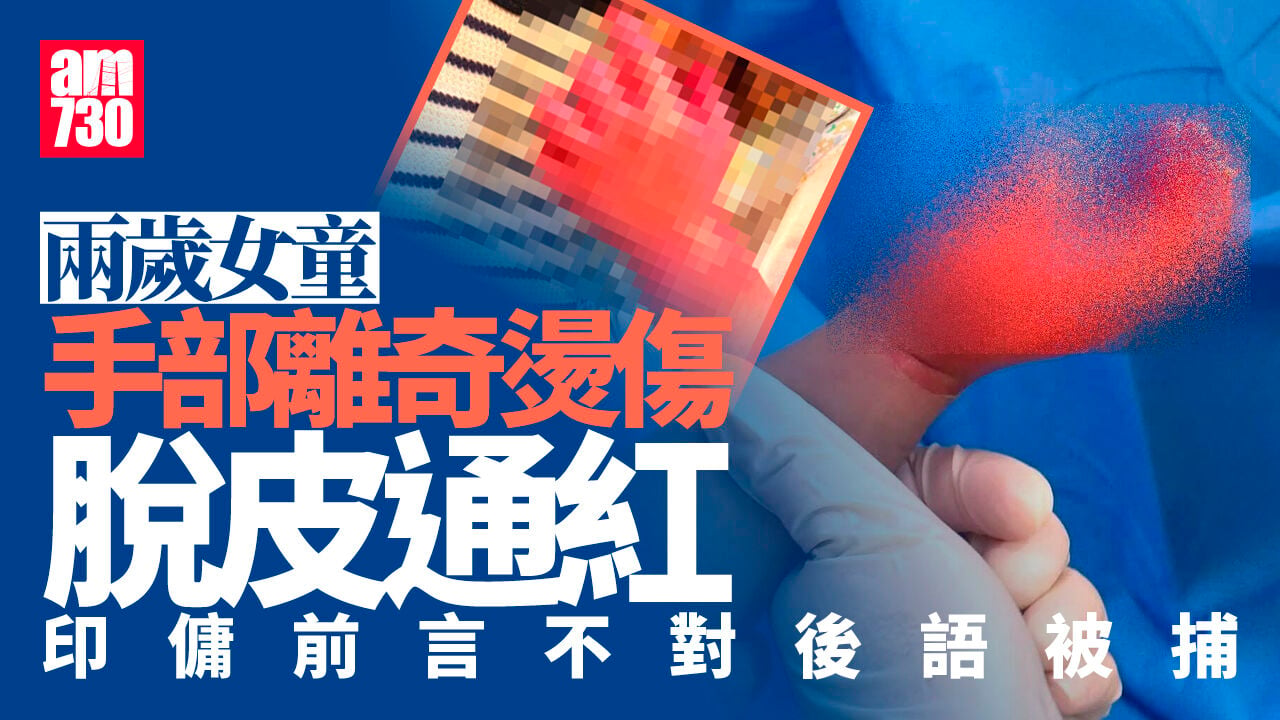 兩歲女童手部二級燒傷疑被虐 30歲印傭前言不對後語被捕