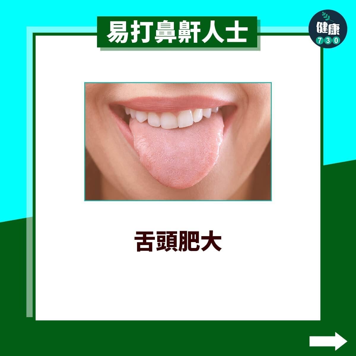 易打鼻鼾人士|舌頭肥大