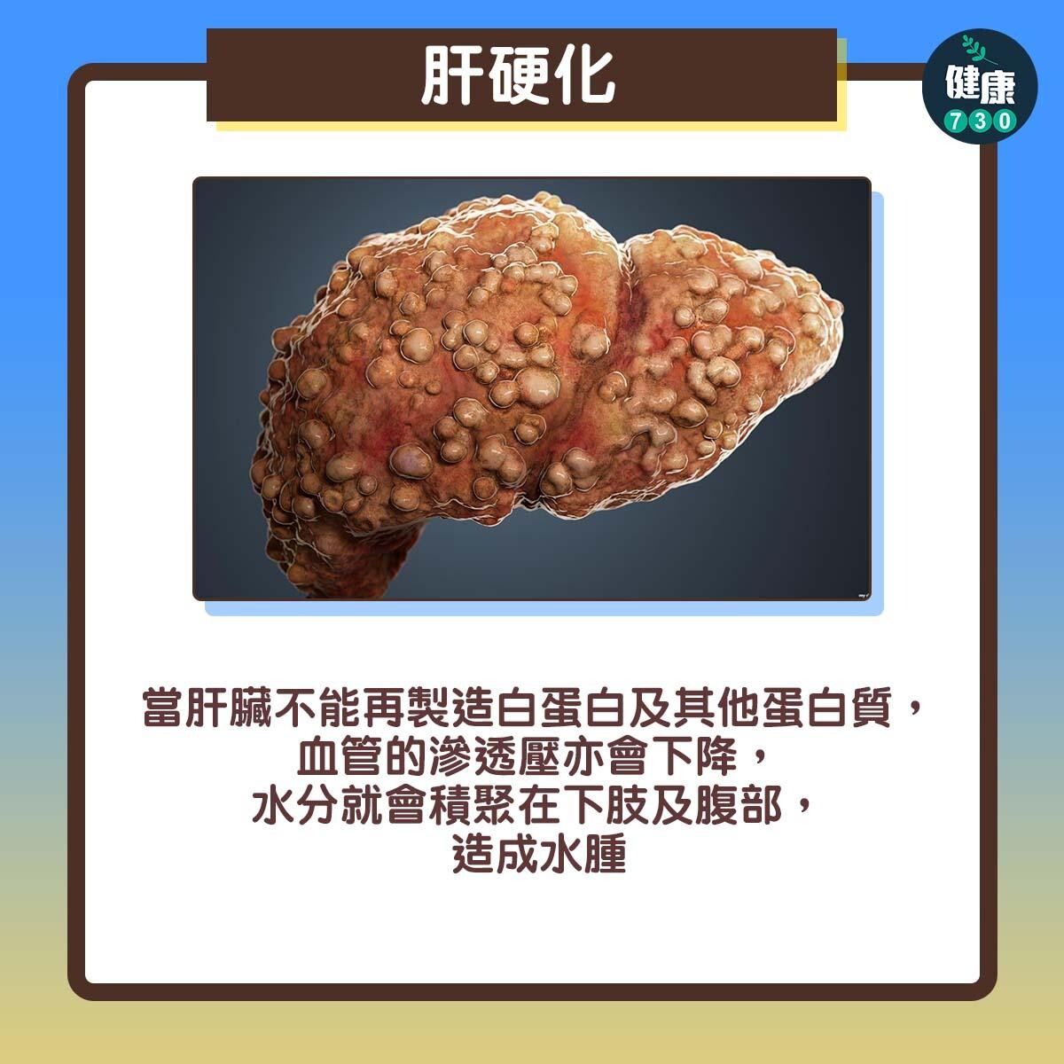 水腫｜自我測試（am730製圖）