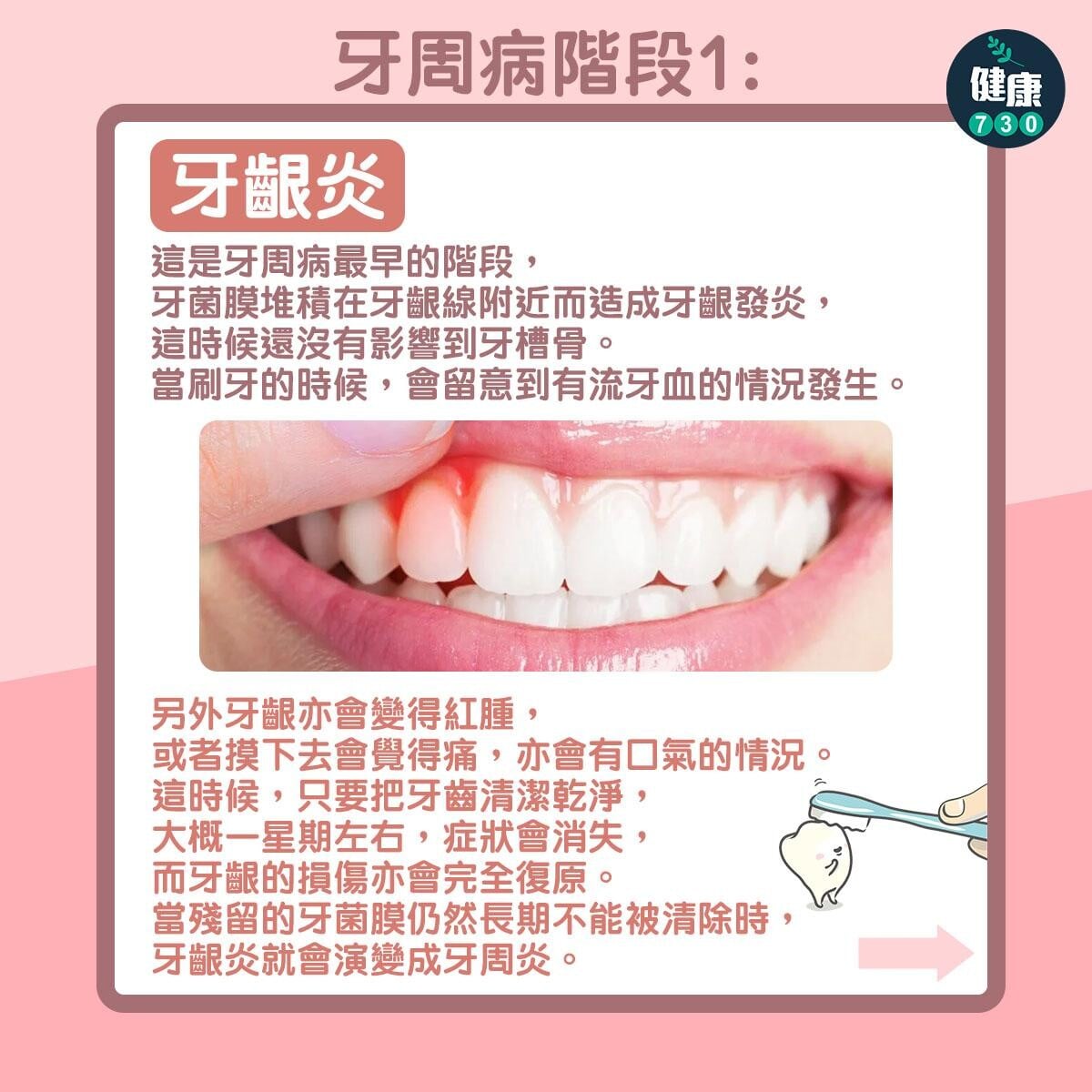 牙周病3個階段,牙膏點揀好?(am730製圖)