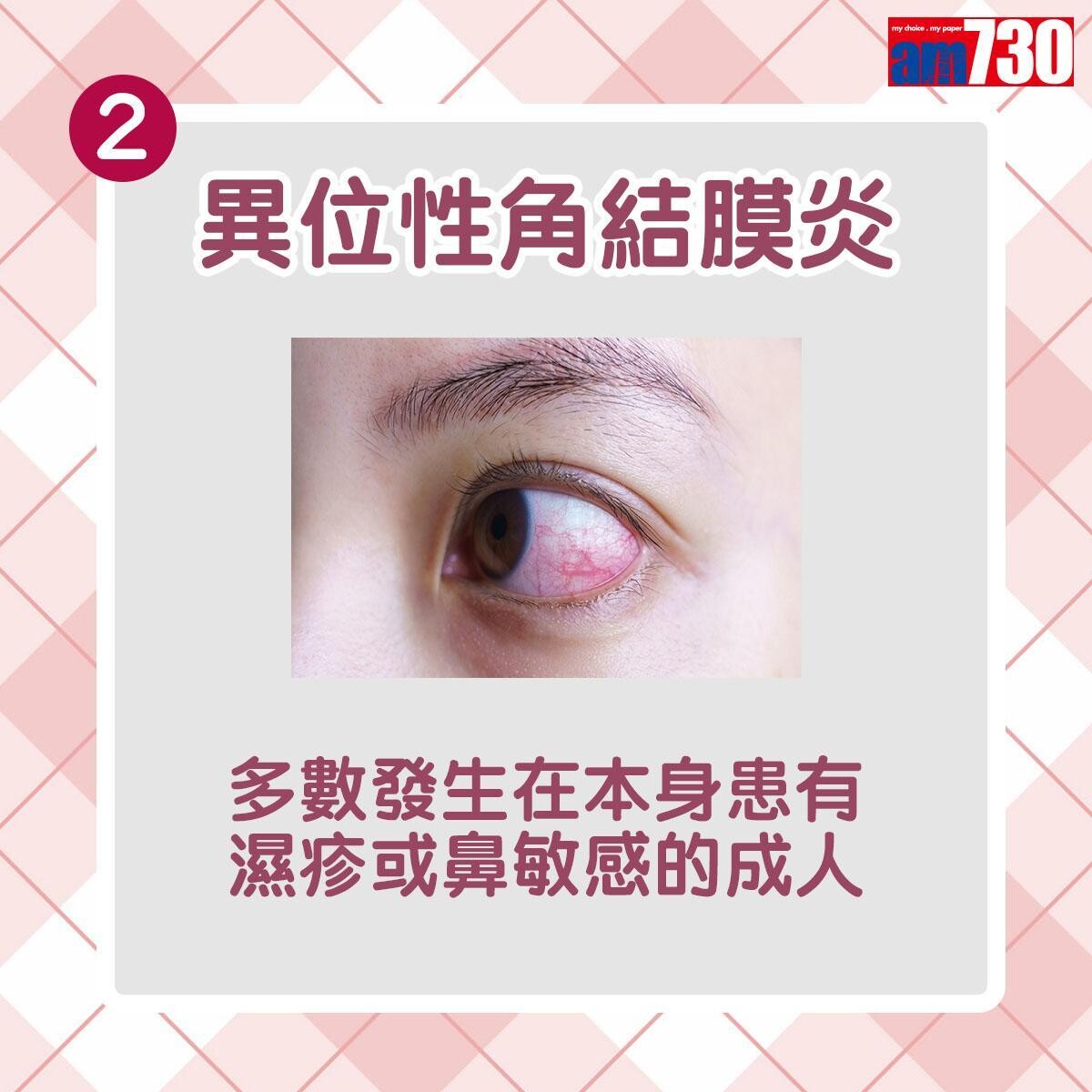 眼晴敏感分3種(am730製圖)