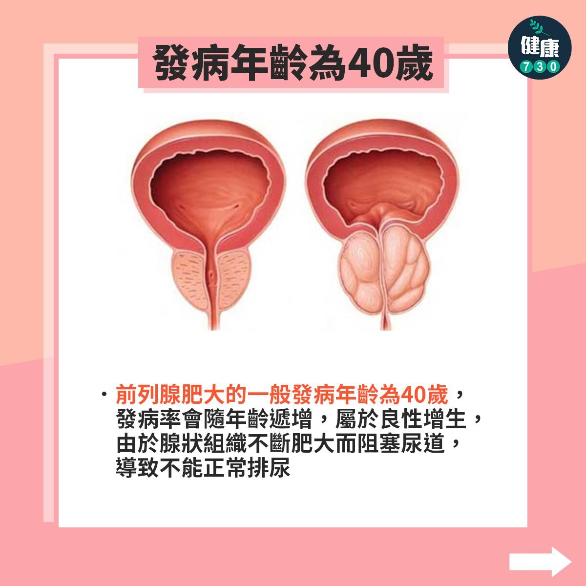 前列腺肥大原因、症狀及預防方法（am730製圖）