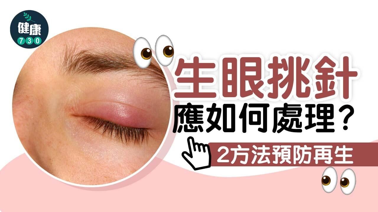 眼挑針｜點解會生眼挑針？應如何處理？2方法預防再生！