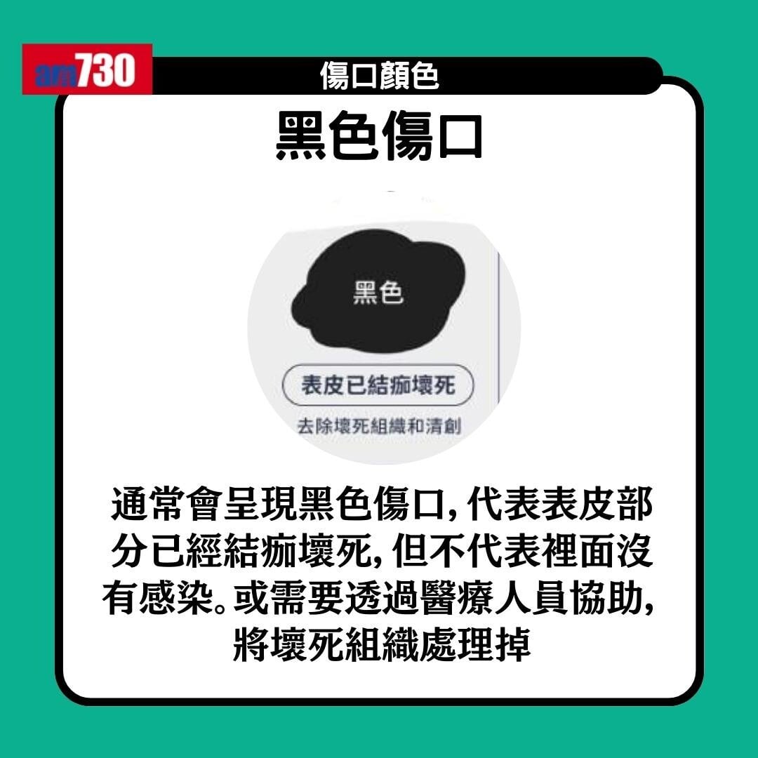 傷口顏色|紅黃綠黑有咩唔同?小心處理加速癒合時間(am730製圖)