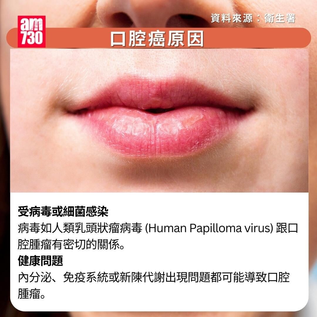 口腔癌原因/症狀/治療/預防方法|原因(am730製圖)