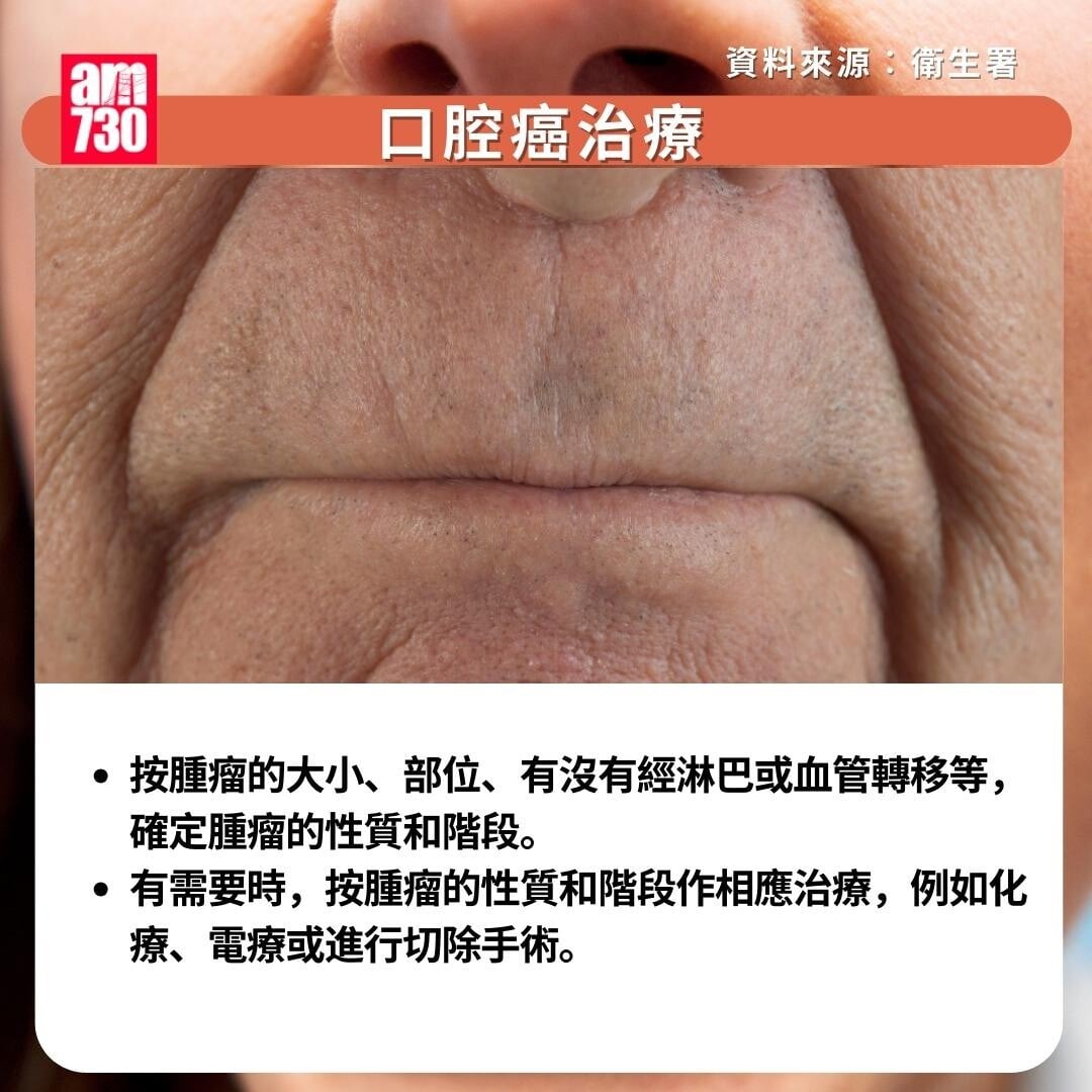 口腔癌原因/症狀/治療/預防方法|治療(am730製圖)