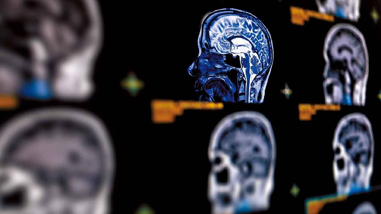 腦內計時炸彈 忽視頭痛死亡率增至五成