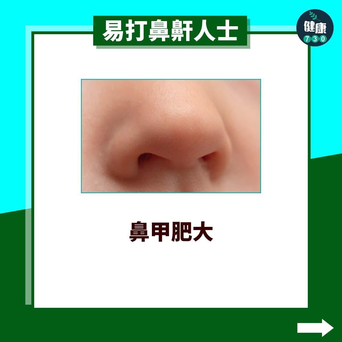 易打鼻鼾人士｜鼻甲肥大（am730製圖）