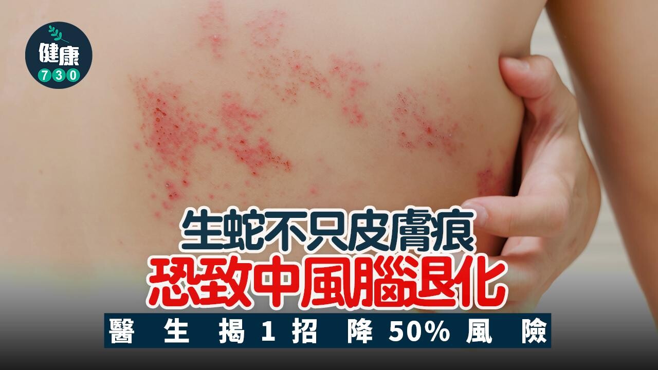 生蛇 中風 心臟病 腦退化 皮膚病 帶狀皰疹