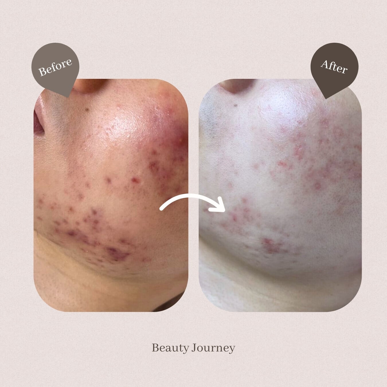 Beauty Journey針清療程