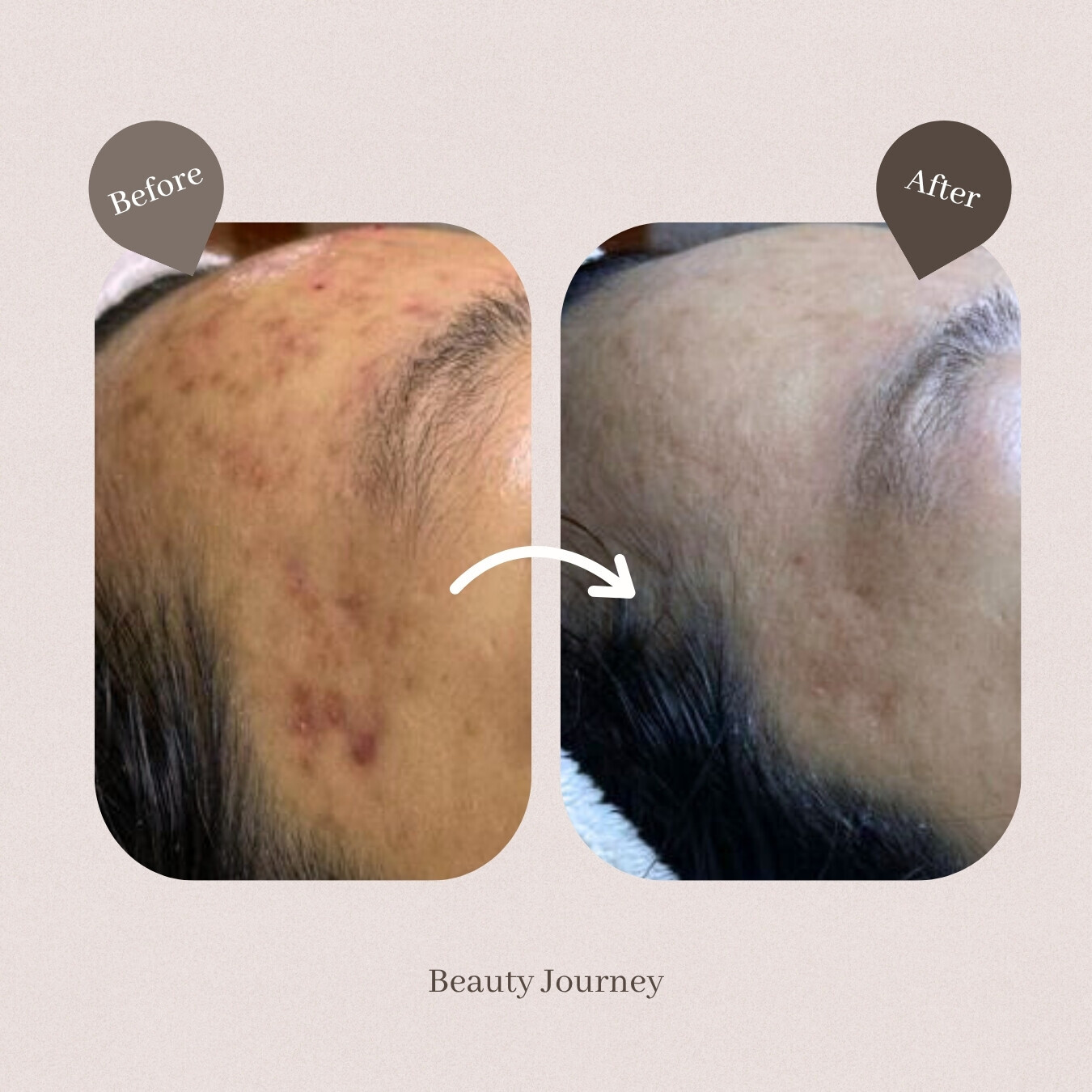 Beauty Journey針清療程