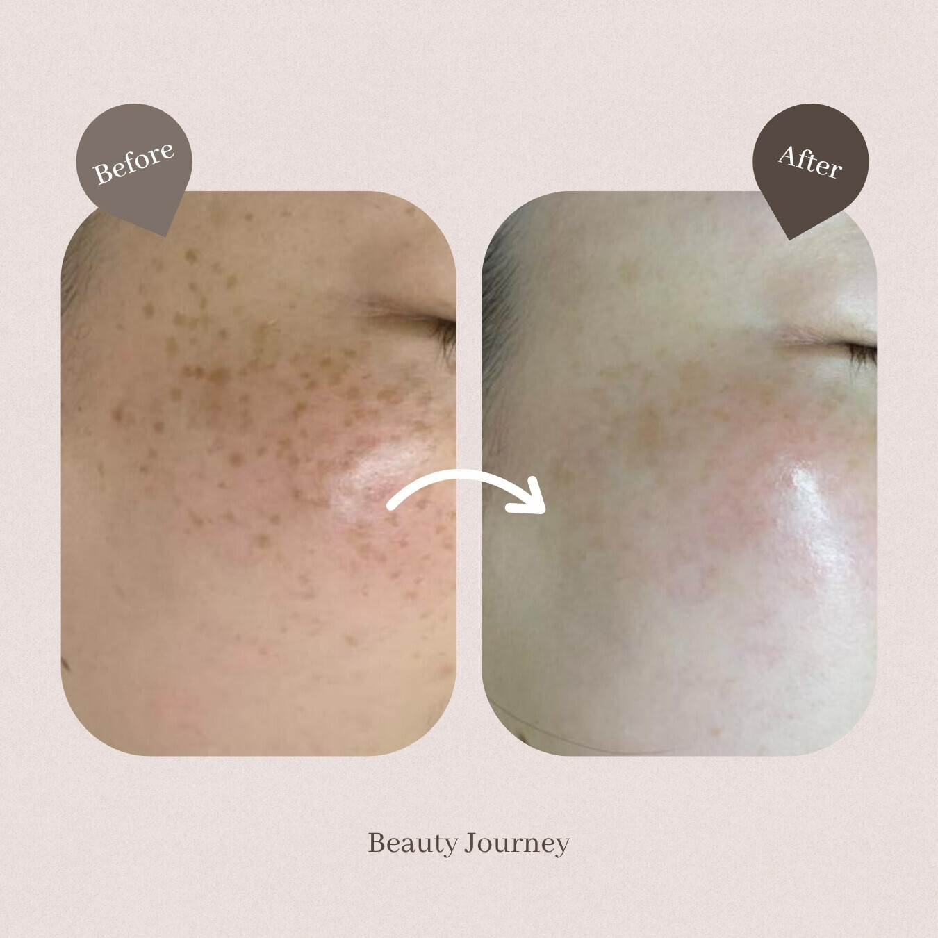 Beauty Journey PICO美白去斑療程