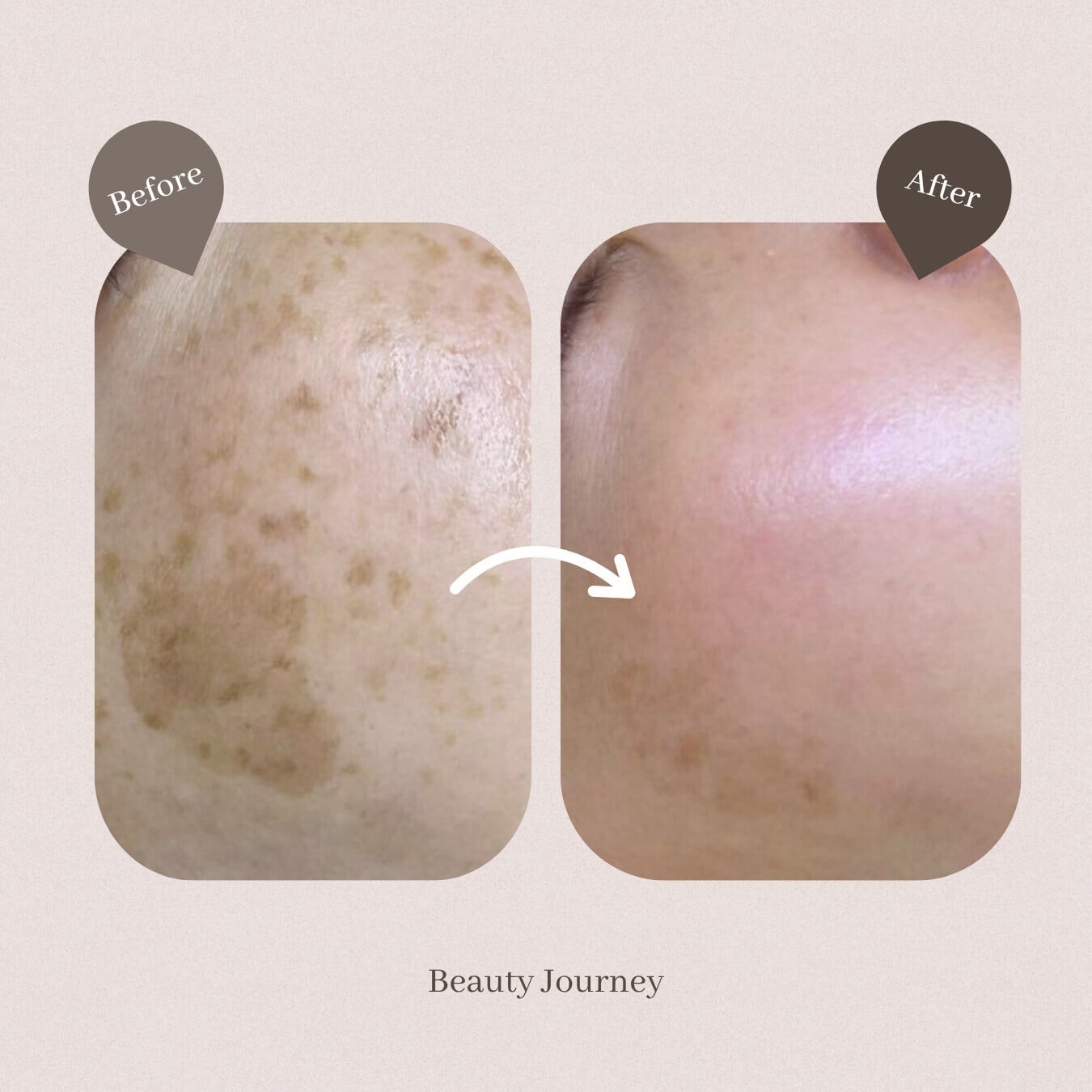 Beauty Journey PICO美白去斑療程