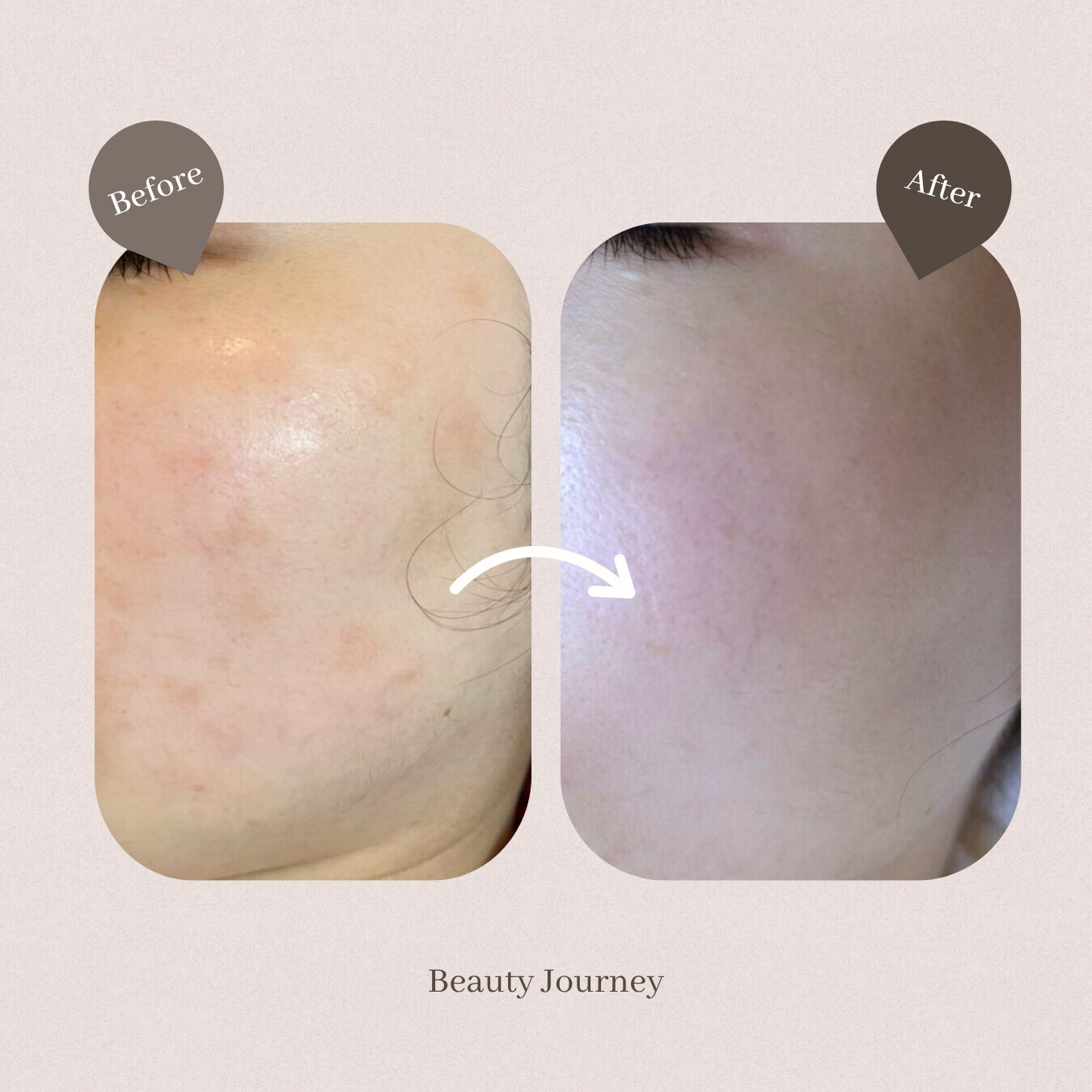 Beauty Journey M22光子嫩膚療程