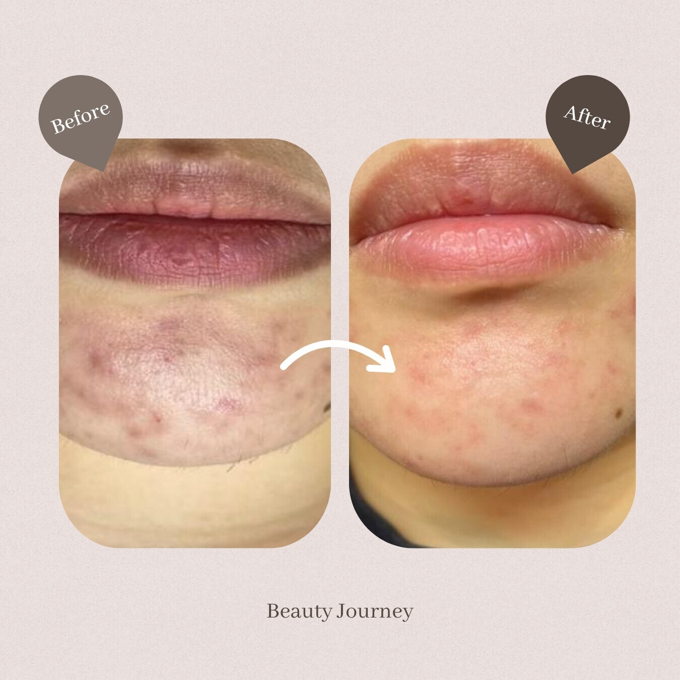Beauty Journey M22光子嫩膚療程