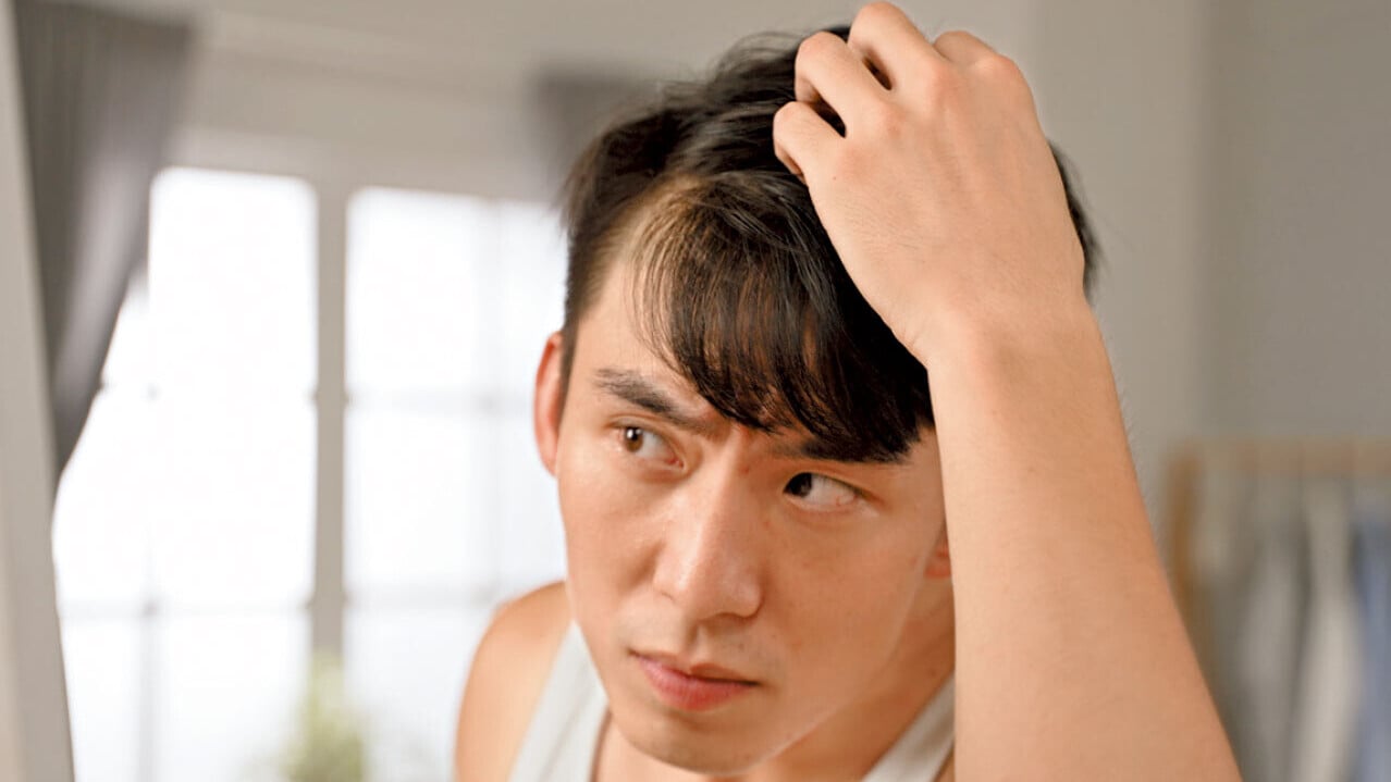 男士脫髮 早治療保髮量