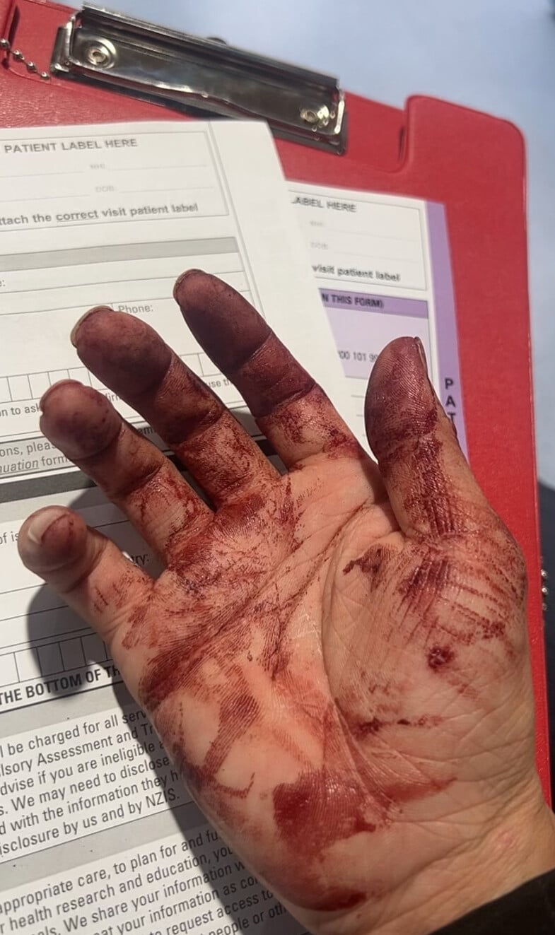 賈星身體多處受傷,並被奪走個人財物。(新西蘭中文先驅報)