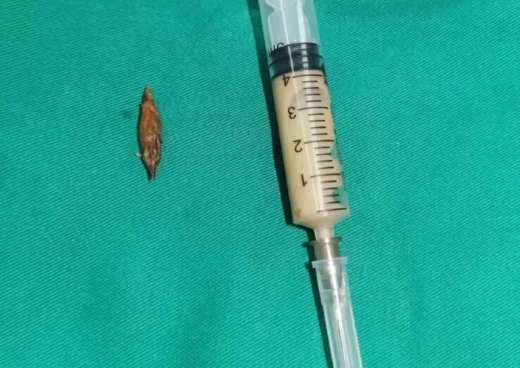 林男腹內棗核成功排出。（圖／翻攝新浪微博）