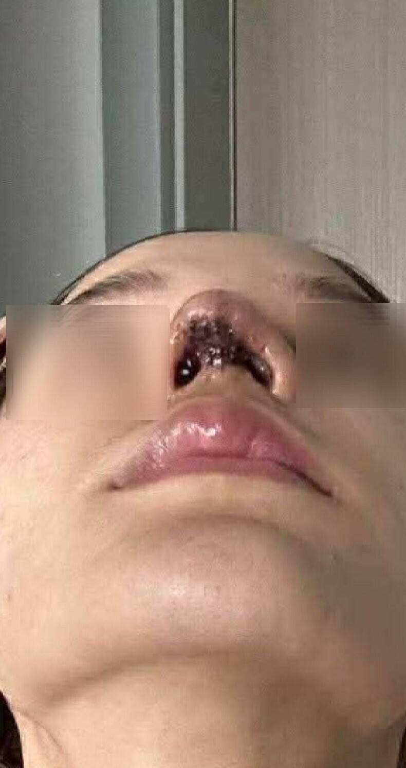 整容