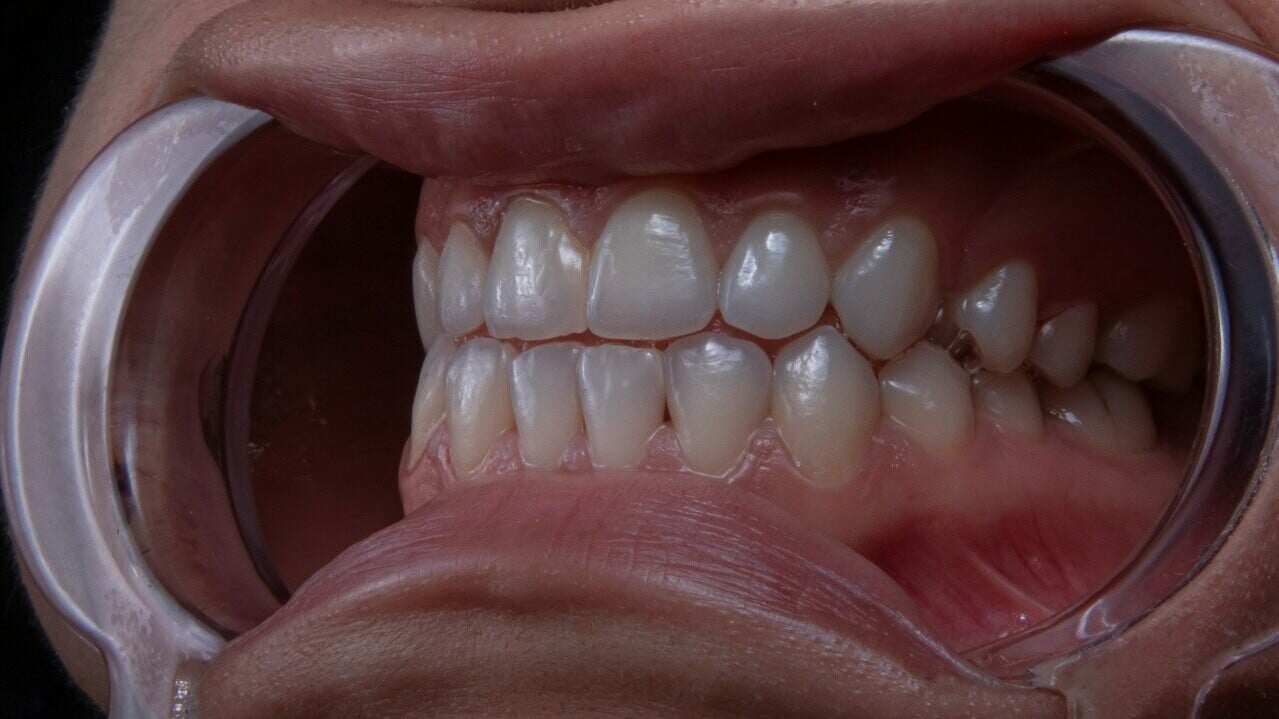 牙根垂直斷裂｜磨牙成隱形兇手 50歲後風險高年輕人近3倍