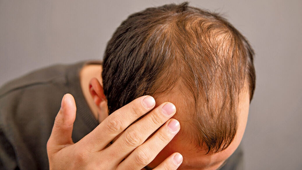 Health 3col male baldness hair loss 79c3025db3
