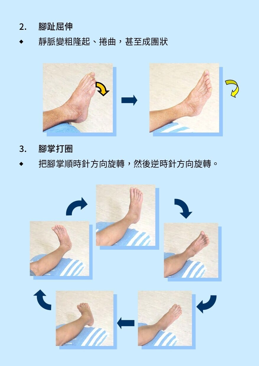 靜脈曲張護理及保健運動，預防及護理（衛生署）