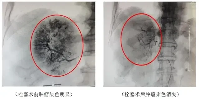 肝惡性腫瘤破裂出血,圖左為手術前CT照片,圖右為手術後