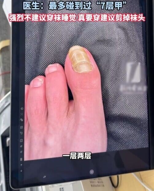 阻生性甲另一病例。(微博)