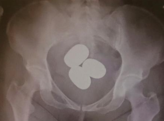 大部分案件涉及走私金粉,包括把金粉用保鮮膜或避孕套包裝再藏於體內。(互聯網)
