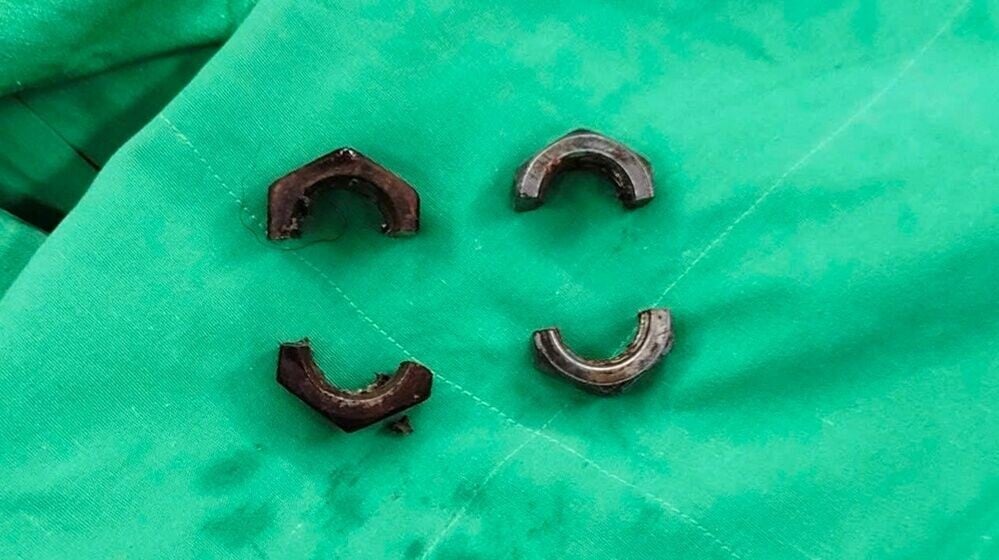 3厘米螺絲帽打孖套陰莖，忍痛1個月潰爛變形始求醫。(X)