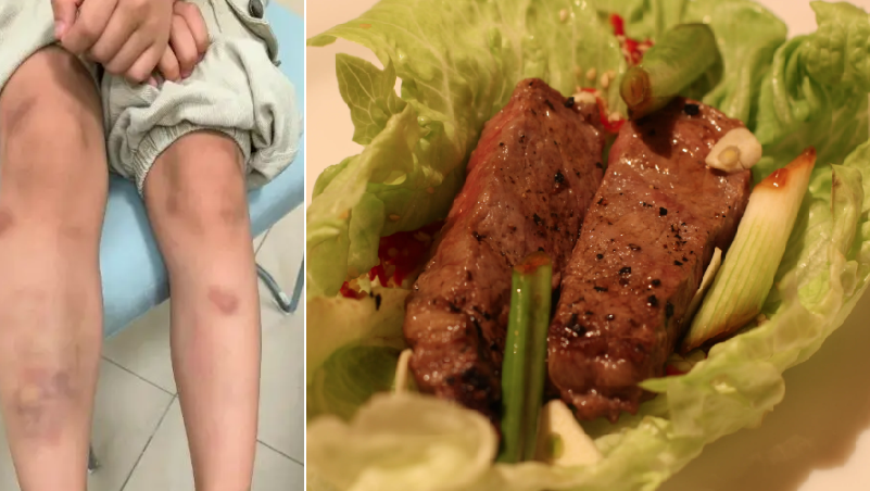 男童進食生菜包後出現離奇瘀痕。(互聯網)