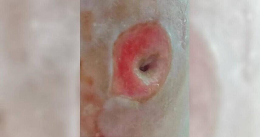 皮脂腺囊腫當暗瘡唧 杭州女臉部「黑洞」或永久留疤