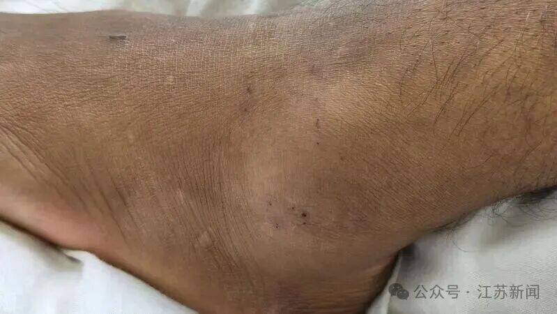 整條左腿已呈現紫黑色腫脹,且傷口持續滲血