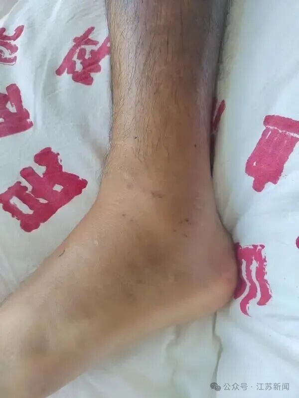 傷者腿部很快出現大片瘀青與腫脹