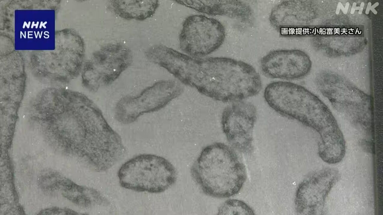 日本麻疹