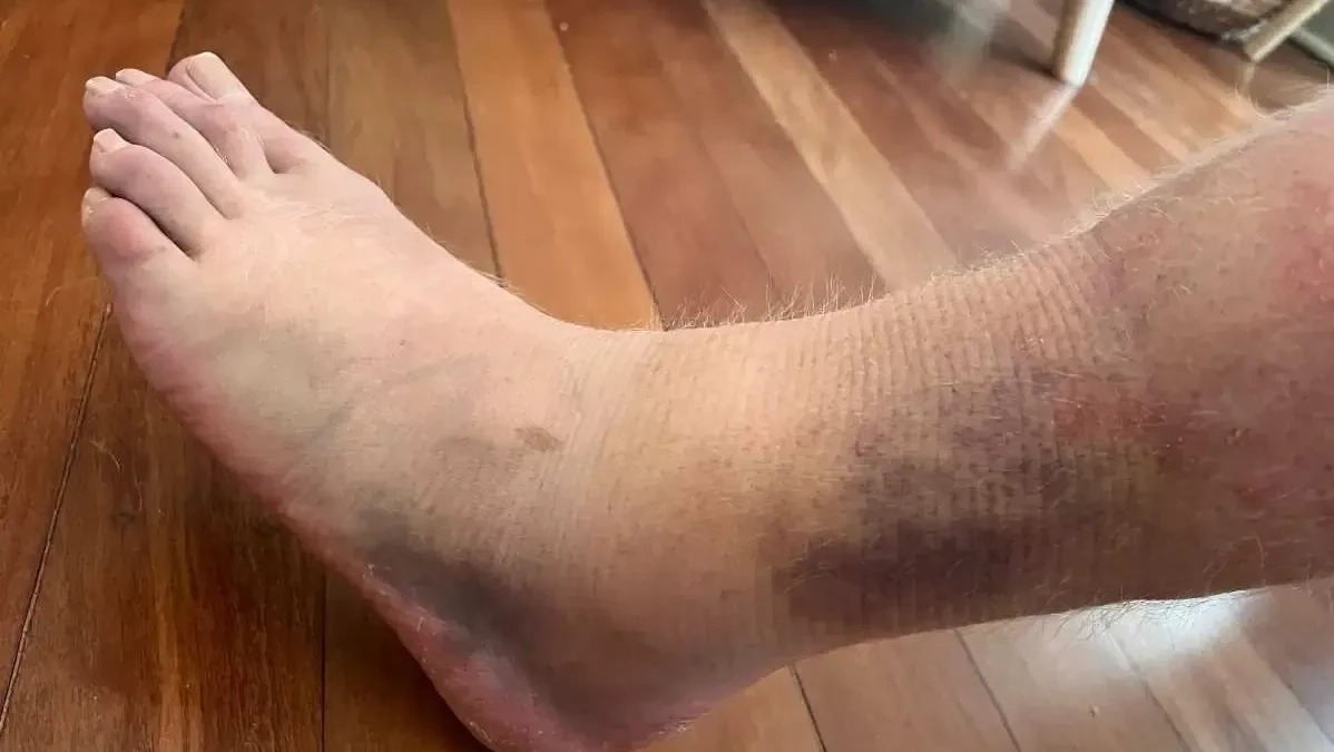 拗柴受傷點醫好？手術與否復康訓練須完成