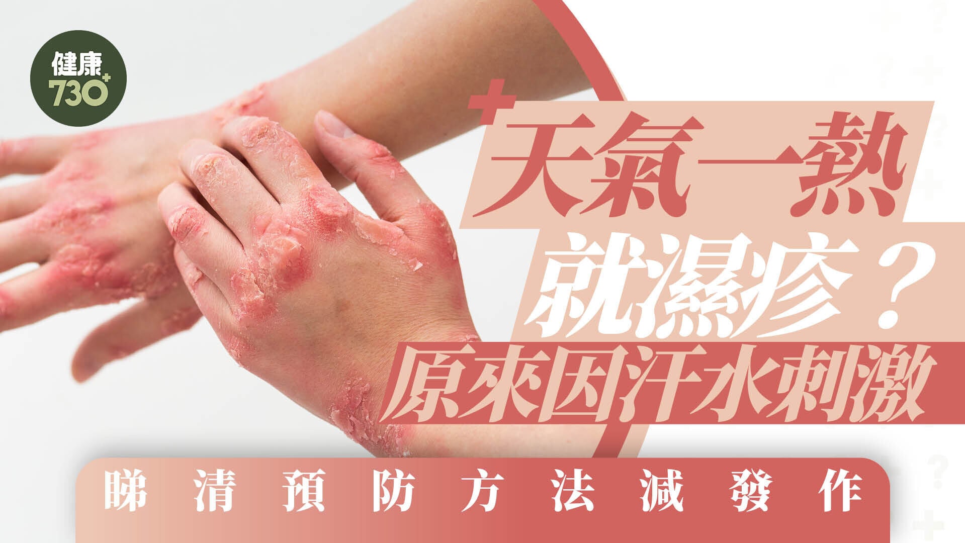 天氣一熱就濕疹？原來因汗水刺激 睇清預防方法減發作