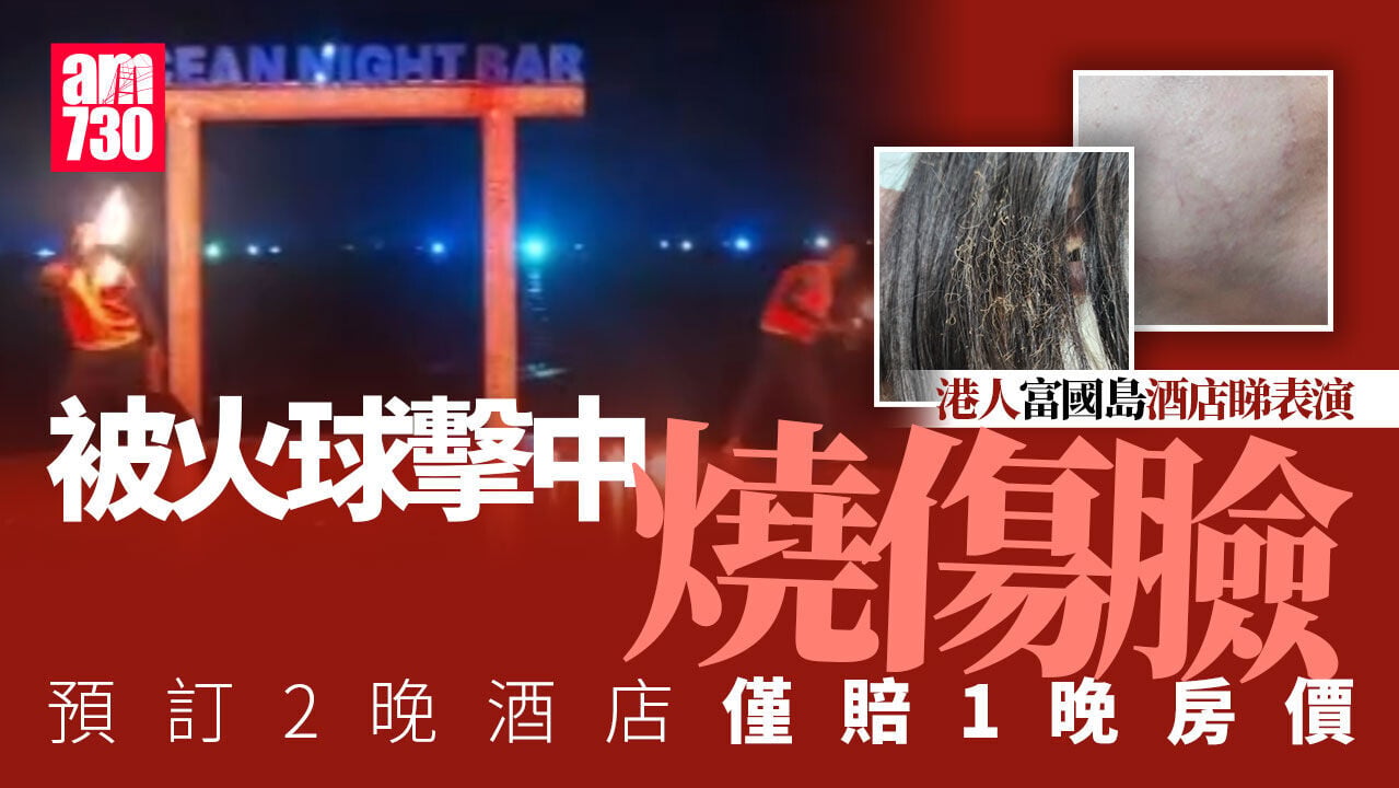 港人富國島酒店看表演遭火球擊中燒傷　不滿只賠償一晚房費(有片)