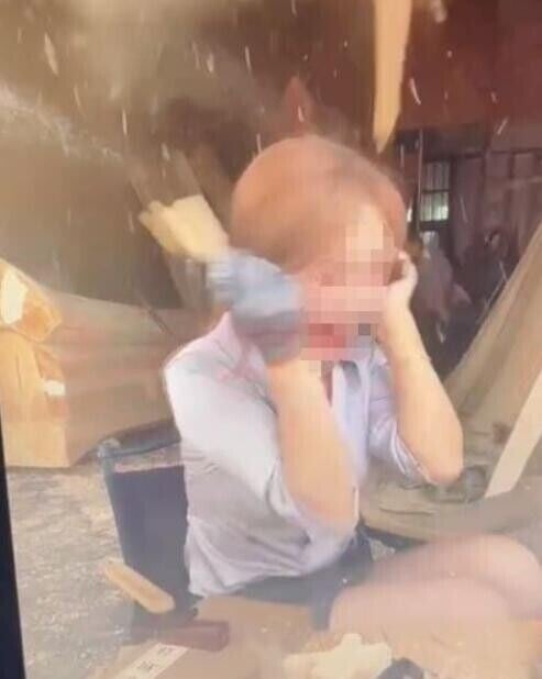 女網紅「思思Alora」臉部與上肢燒傷