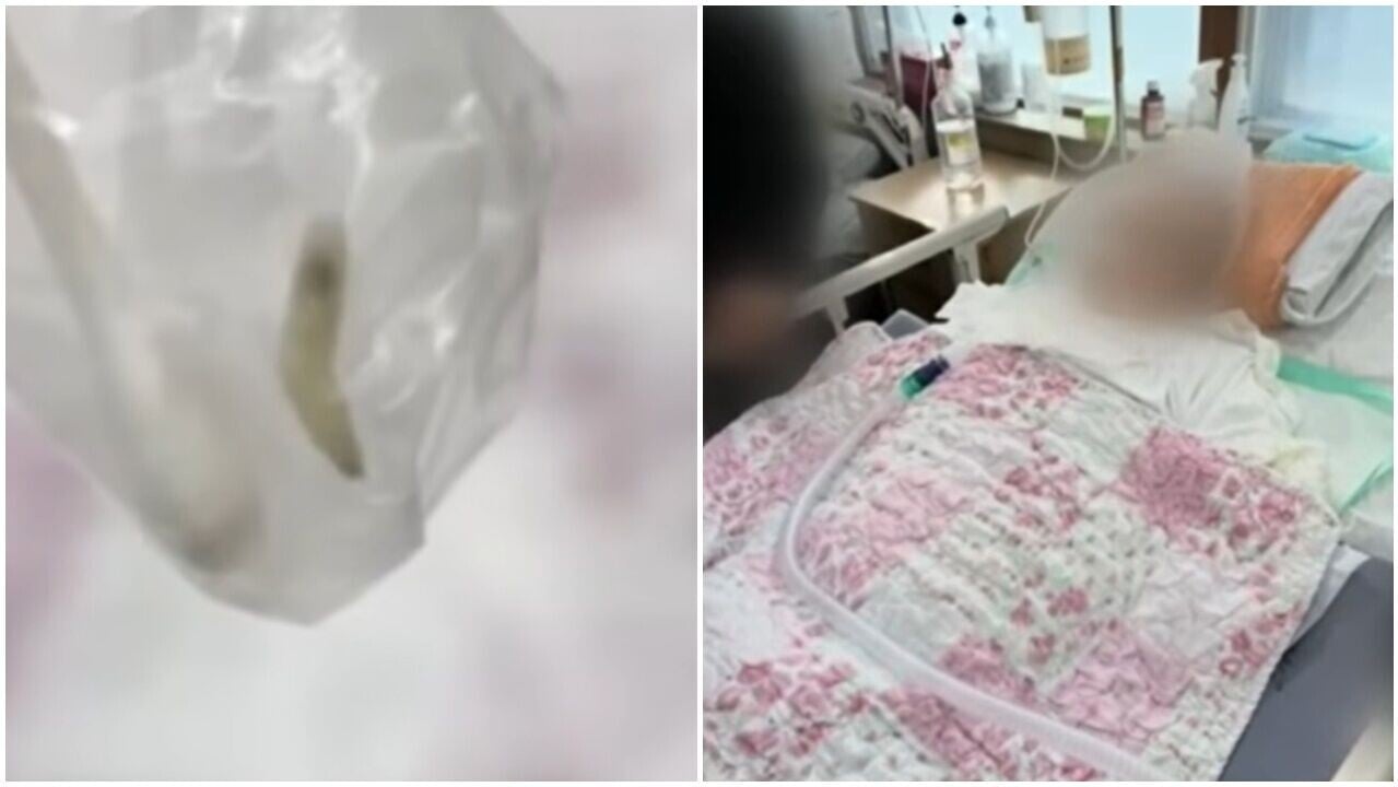 七旬老人鼻腔挖出蛆蟲與蟲卵，爆療養院醫療過失。(YouTube)