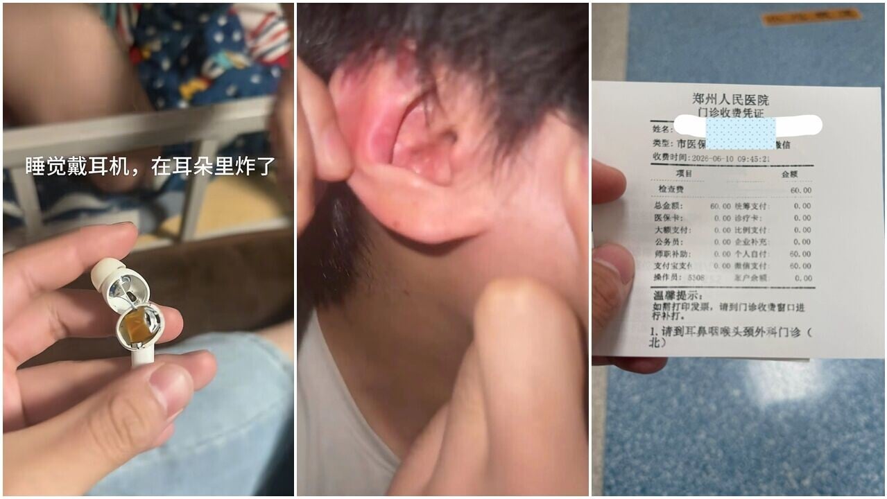 男大學生的藍芽耳機突然爆炸，導致耳朵出現輕微耳鳴及局部灼燒感。(瀟湘晨報)