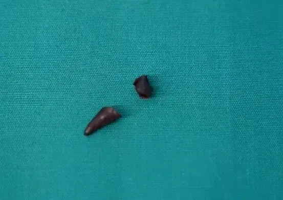 最後證實辣椒尖卡肺,虛驚一場