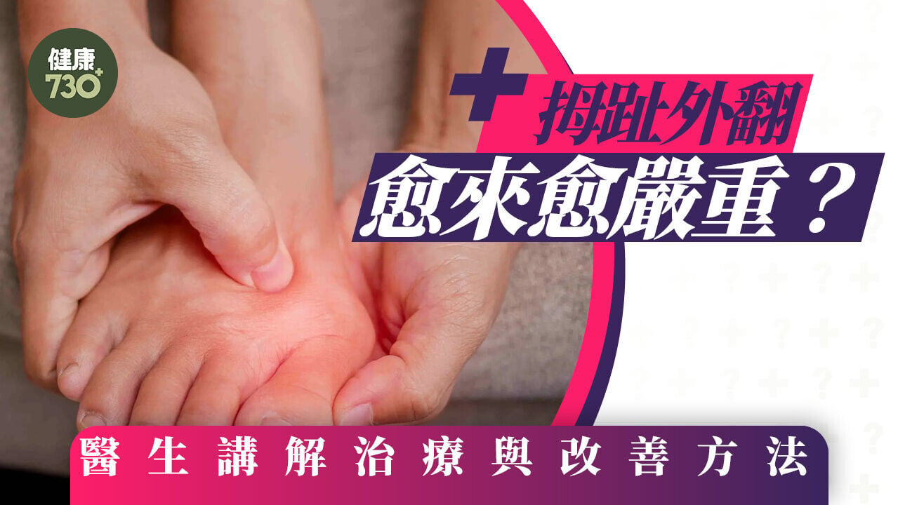 拇趾外翻愈來愈嚴重？醫生講解治療與改善方法